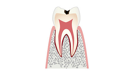 C1 エナメル質の虫歯