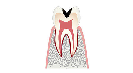 C2 虫歯が象牙質まで進行