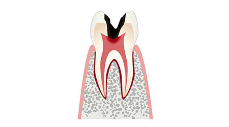 C3 虫歯が神経まで進行