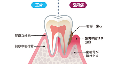 歯周病の原因