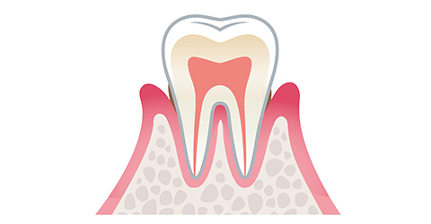 歯周炎(軽度)