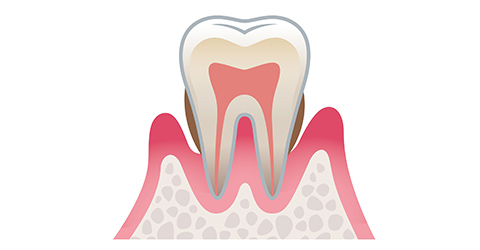 歯周炎(中度)