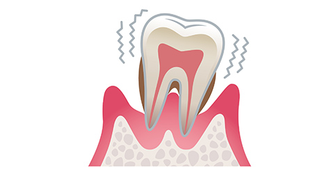 歯周炎(重度)